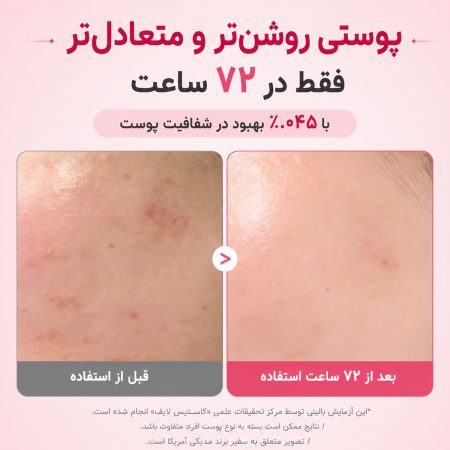 سرم ضد لک و روشن کننده نیاسینامید و ترانگزامیک اسید مدی کیوب 7 نتایج کلینیکال سرم ضد لک و روشن کننده نیاسینامید و ترانگزامیک اسید مدی کیوب