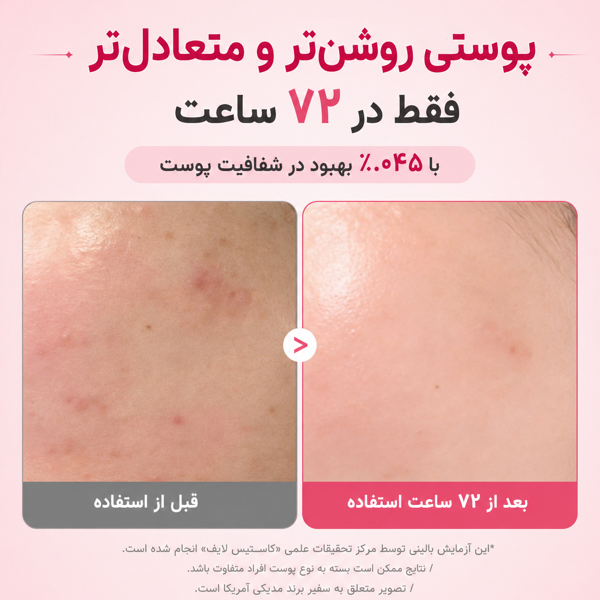 سرم ضد لک و روشن کننده نیاسینامید و ترانگزامیک اسید مدی کیوب 4 نتایج کلینیکال سرم ضد لک و روشن کننده نیاسینامید و ترانگزامیک اسید مدی کیوب