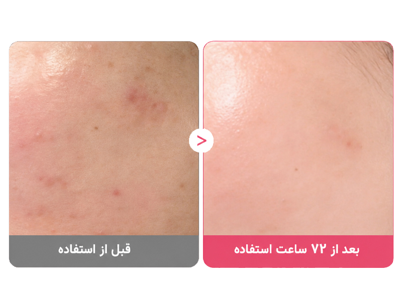 سرم ضد لک و روشن کننده نیاسینامید و ترانگزامیک اسید مدی کیوب 9 نتایج کلینیکال