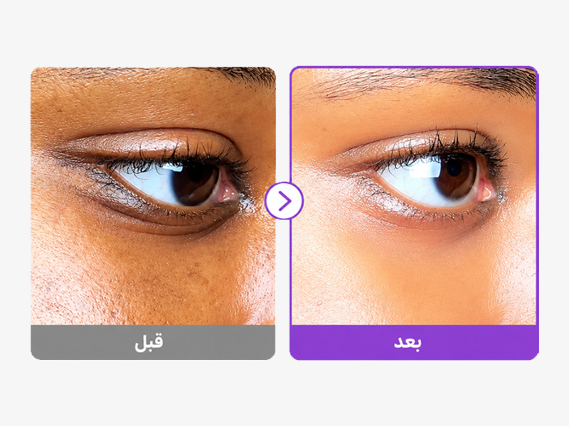 نتیجه استفاده دور چشم نامبوزین