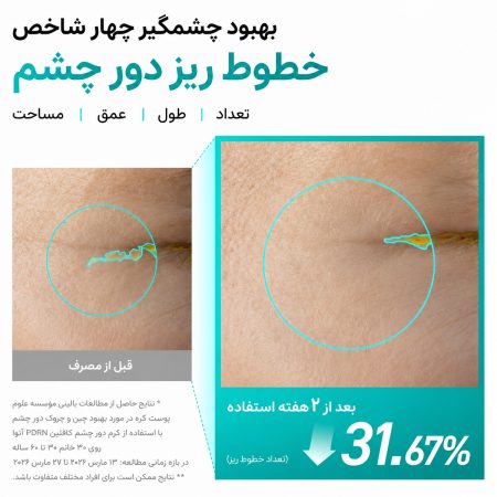 کرم دور چشم جوانساز PDRN و کافئین آنوا 15 نتیجه استفاده از کرم دور چشم جوانساز PDRN و کافئین آنوا