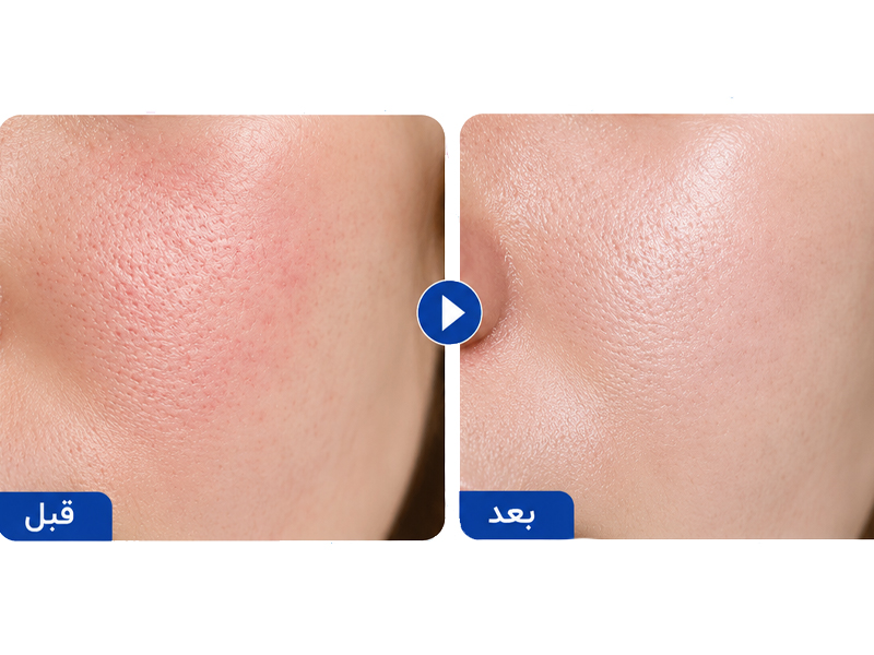 کرم دابل آپ اکتوئین و پنتنول ای پی 18 نتایج کلینیکال