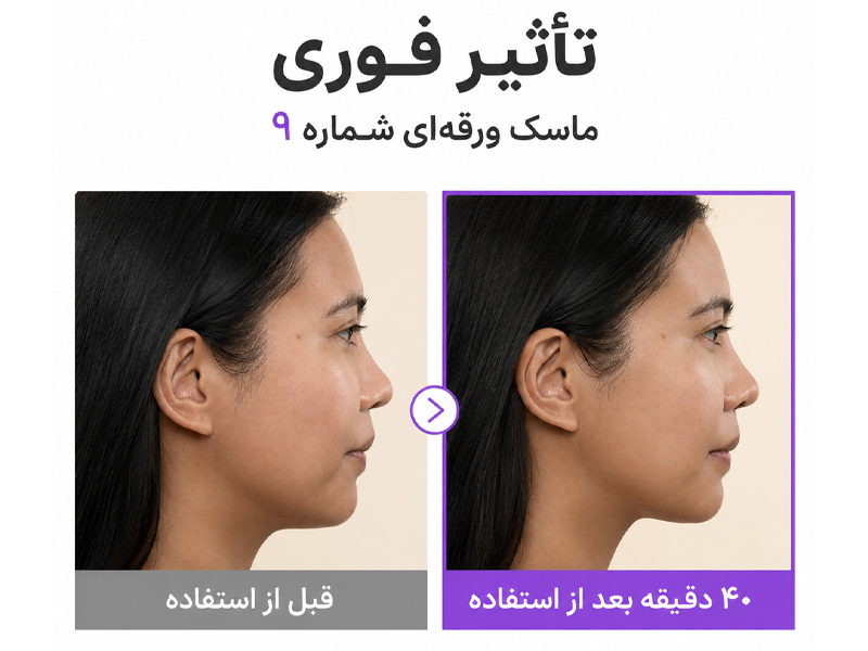 نتایج کلینیکال ماسک لیفتینگ +NAD نامبوزین شماره 9