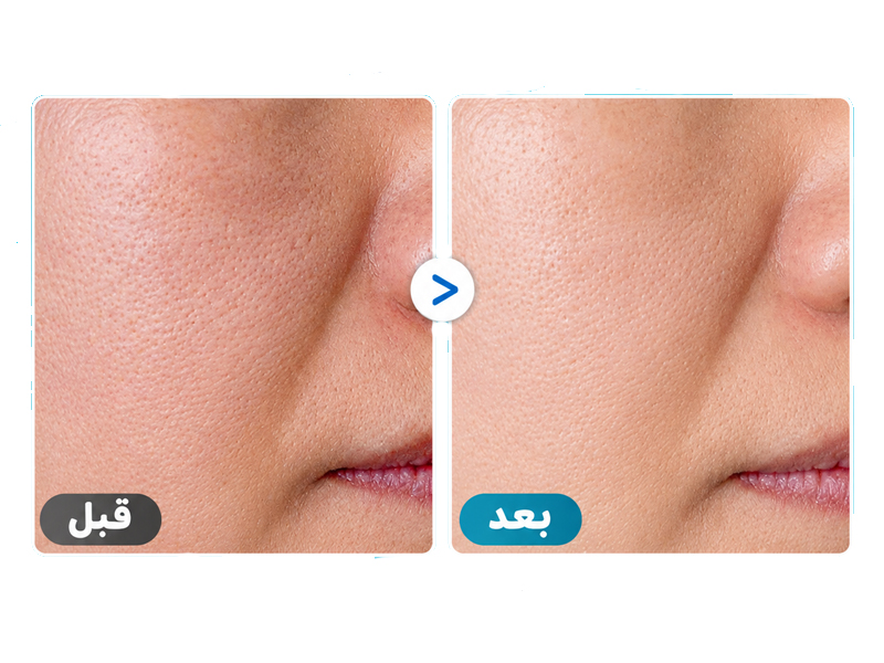 سرم پیل شات ترانگزامیک اسید روشن کننده و لایه بردار ملایم دکتر ملاکسین 12 نتایج کلینیکال